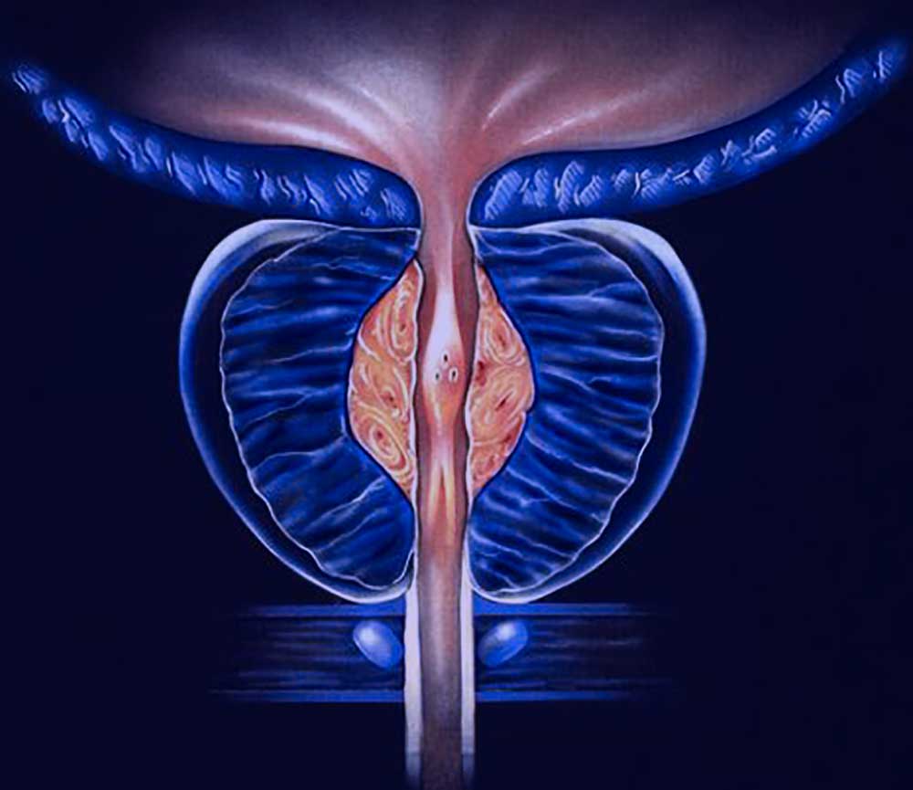 prostate-health